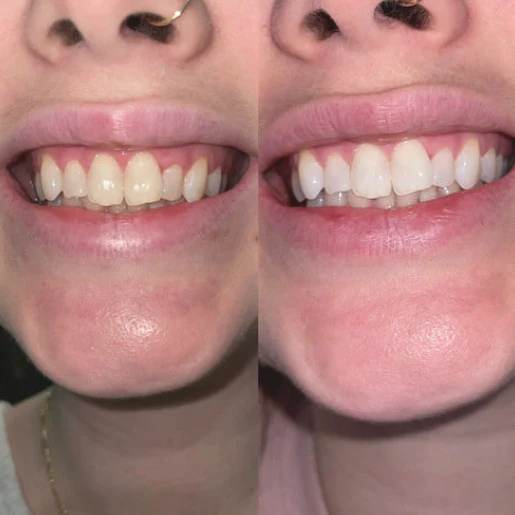 La misma sonrisa, antes y después