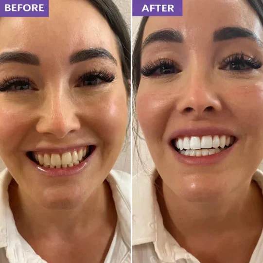 Antes y después, sonrisa completa